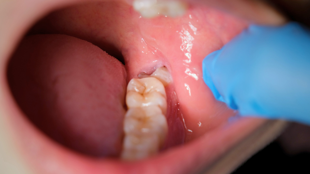 Foto tunas gigi bungsu yang mengalami masalah pertumbuhan