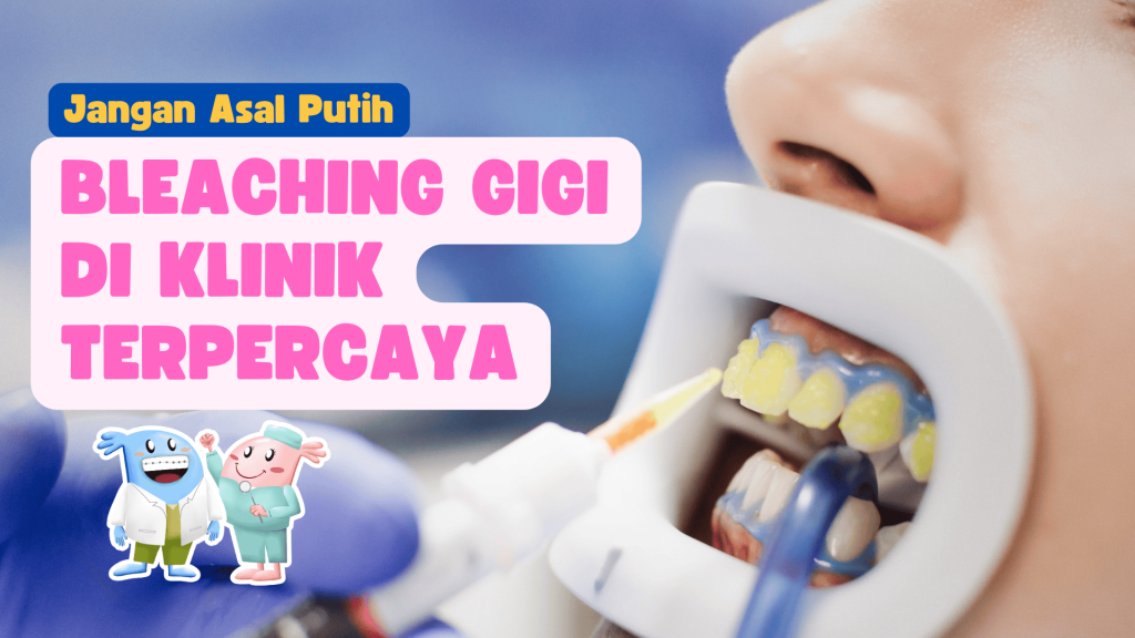 Pasien melakukan bleaching gigi di klinik terpercaya dengan gel pemutih dan pelindung mulut, disertai ilustrasi edukatif “Jangan Asal Putih”.